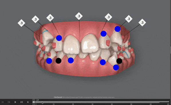 Planificación Alineadores