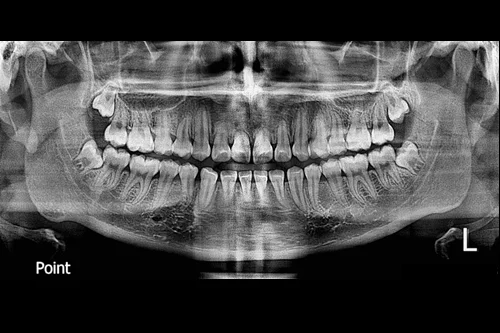 Radiografía Panorámica Dental