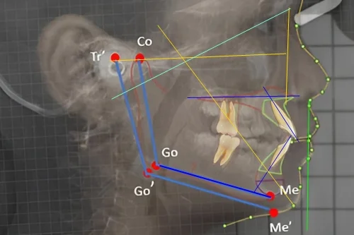 Trazado cefalométrico ortodoncia