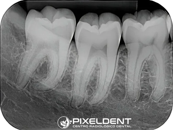 radiografía periapical digital en Lima