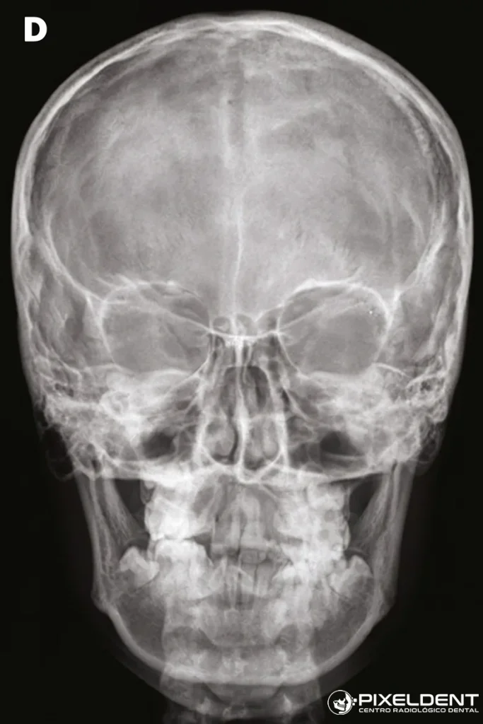 Radiografía Frontal (Posteroanterior - PA) en Lima